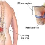Triệu chứng lâm sàng của thoát vị đĩa đệm cột sống thắt lưng
